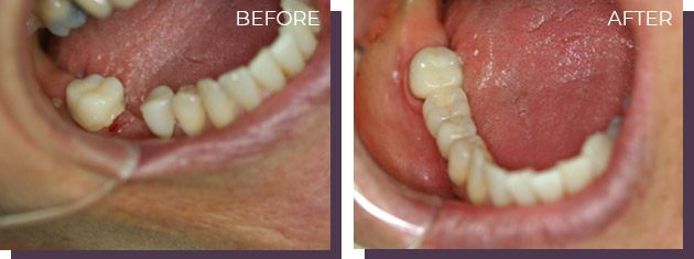 Bridging - Before and After