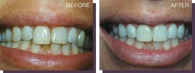 Contouring - Before and After