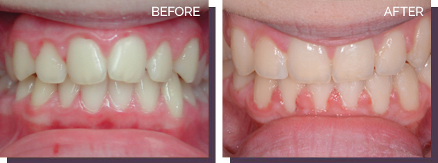 Invisalign - Before and After 5