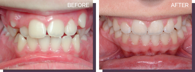 Invisalign - Before and After 6