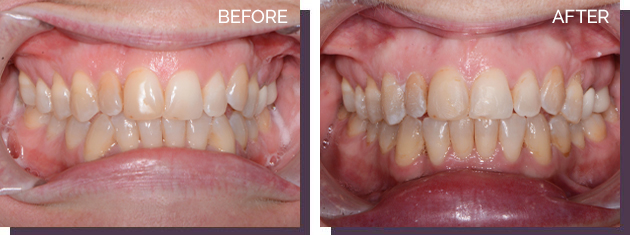Invisalign - Before and After Results 10
