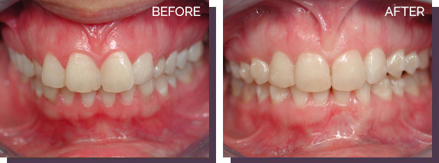 Invisalign - Before and After Results 11