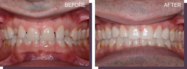 Invisalign - Before and After Results 12