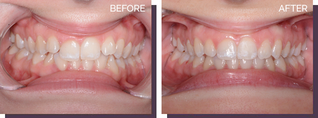 Invisalign - Before and After Results 13