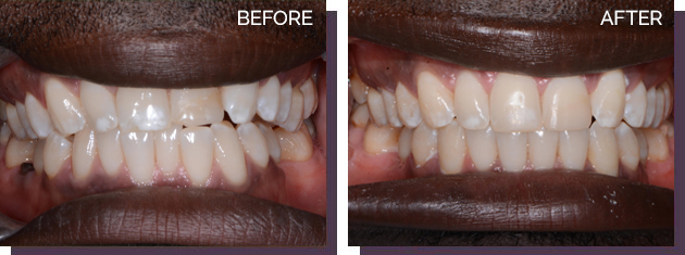 Invisalign - Before and After Results 14