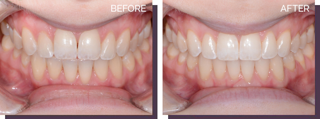 Invisalign - Before and After Results 15
