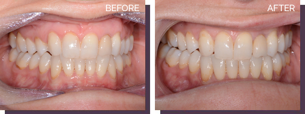 Invisalign - Before and After Results 16