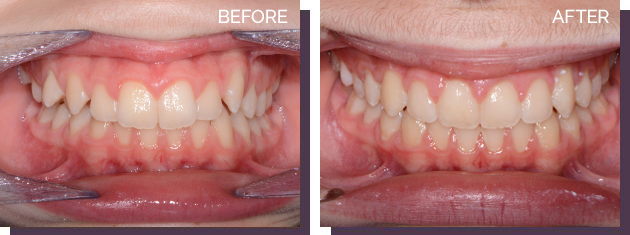 Invisalign - Before and After Results 18