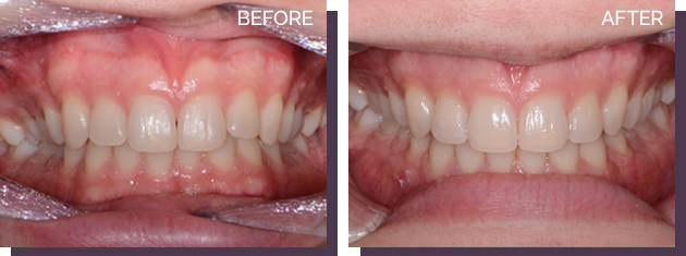 Invisalign - Before and After Results 19
