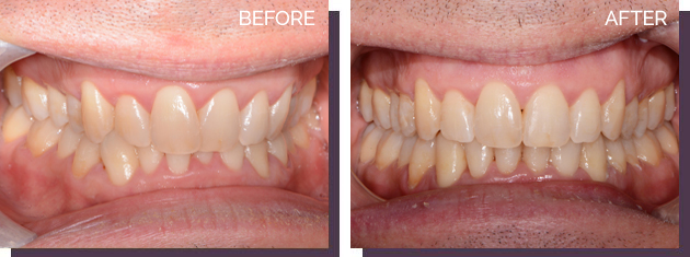 Invisalign - Before and After Results 20