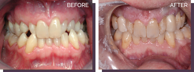 Invisalign - Before and After Results 21