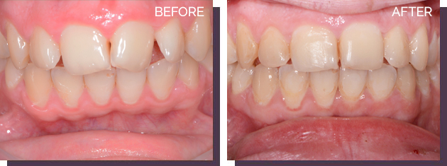 Invisalign - Before and After Results 22