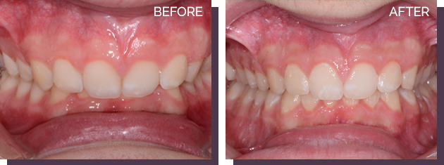 Invisalign - Before and After Results 23