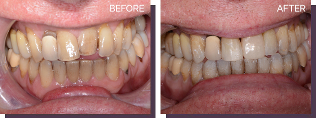 Invisalign - Before and After Results 24