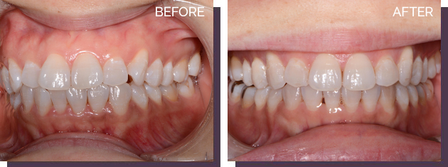Invisalign - Before and After Results 25