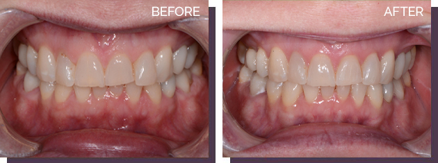 Invisalign - Before and After Results 26