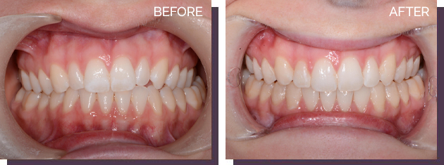Invisalign - Before and After Results 27