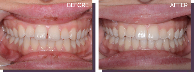 Invisalign - Before and After Results 28