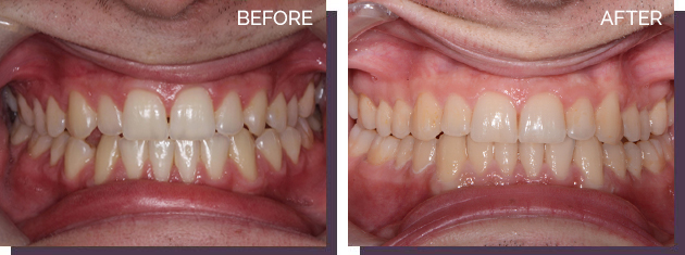 Invisalign - Before and After Results 29