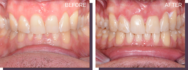 Invisalign - Before and After Results 30