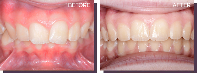 Invisalign - Before and After Results 5
