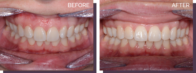 Invisalign - Before and After Results 7