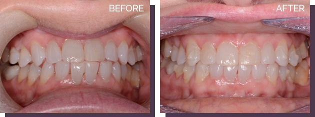 Invisalign - Before and After Results 8