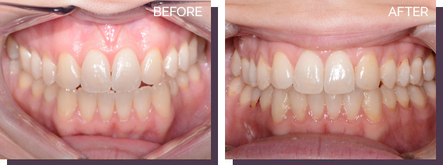 Invisalign - Before and After Results 9