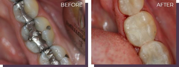 Tooth Coloured Fillings - Before and After