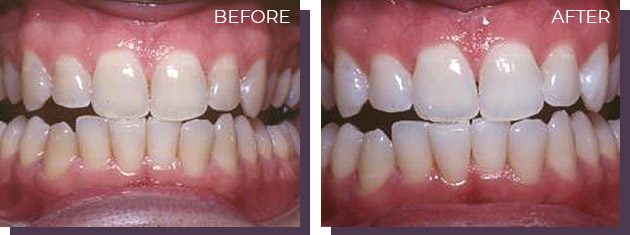 Whitening - Before and After