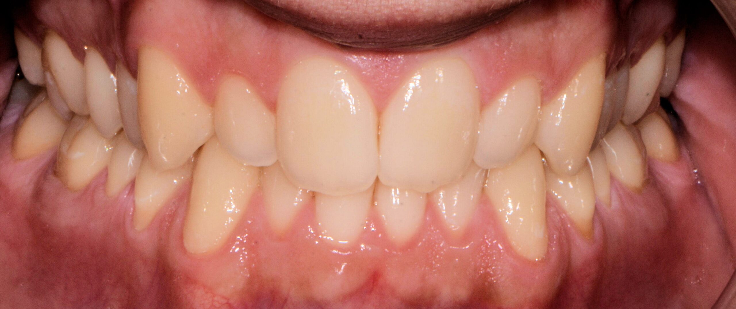 Before treatment