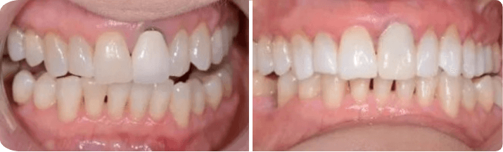 CEREC Same-Day Crowns