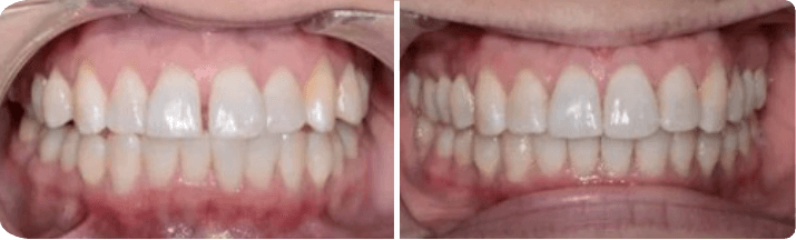 Invisalign (Completed In 1 Year)