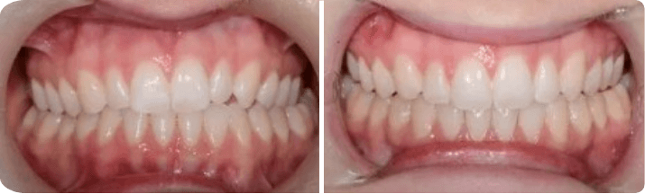 Invisalign (Completed In 1 Year)