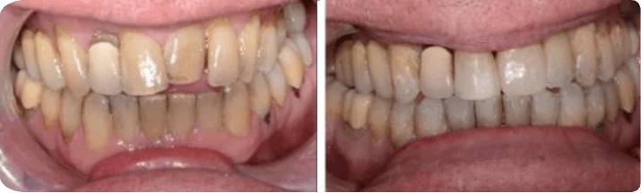 Invisalign (Completed In 1.11 Years)