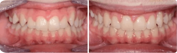 Invisalign (Completed In 1.3 Years)