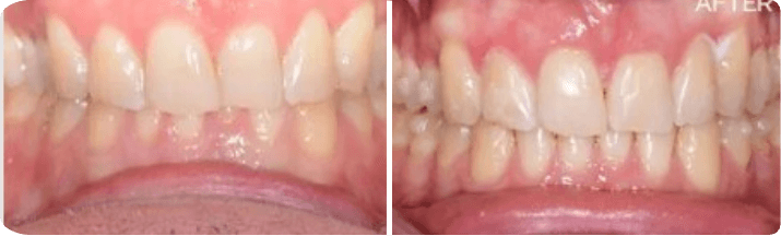 Invisalign (Completed In 1.4 Months)