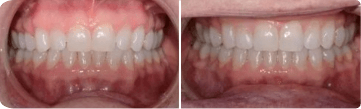 Invisalign (Completed In 10 Months)
