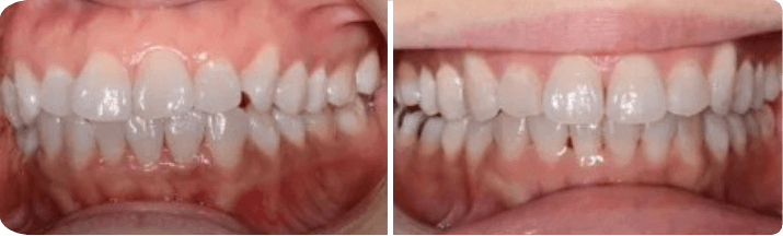 Invisalign (Completed In -10
