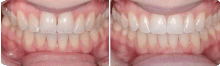 Invisalign (Completed In 11 Months)