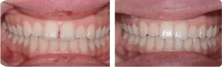 Invisalign (Completed In -11