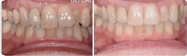 Invisalign (Completed In -12