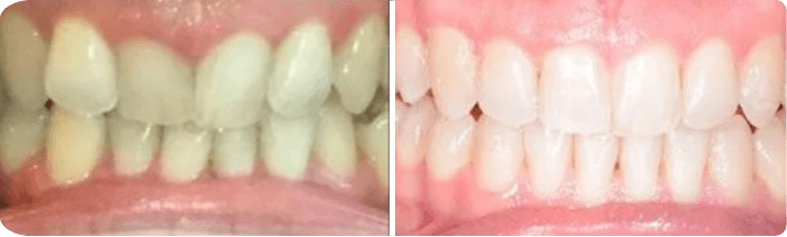 Invisalign (Completed In -13