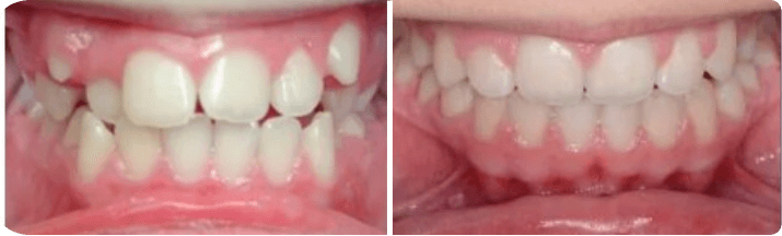 Invisalign (Completed In -17