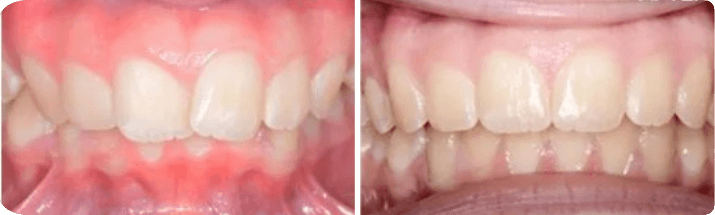 Invisalign (Completed In 2.4 Years)