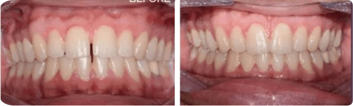 Invisalign (Completed In 5 Months)