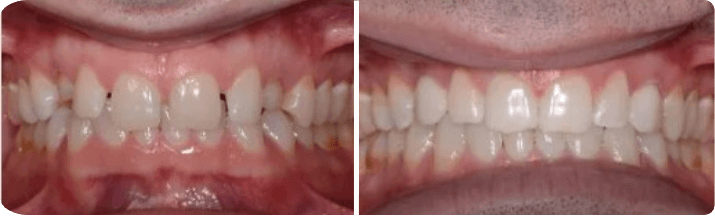 Invisalign (Completed In 6 Months)