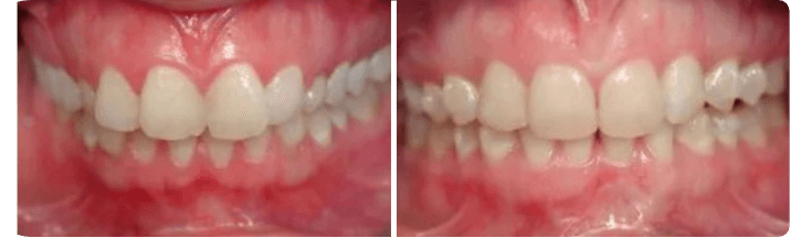Invisalign (Completed In 6 Years)