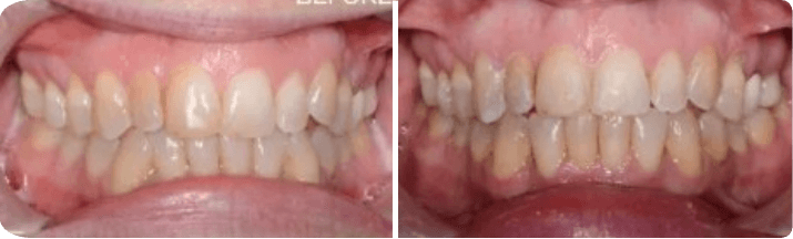 Invisalign (Completed In 7 Months)