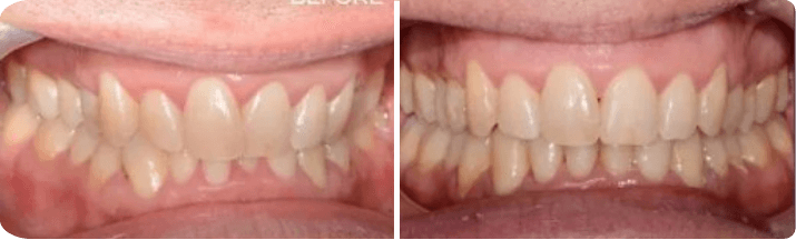 Invisalign (Completed In -8